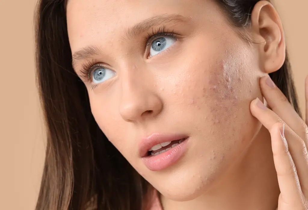 Acne Severity and Skin Damage We Manage