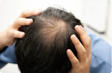 Hair Loss