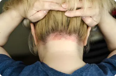 Hair & Nail Disorders