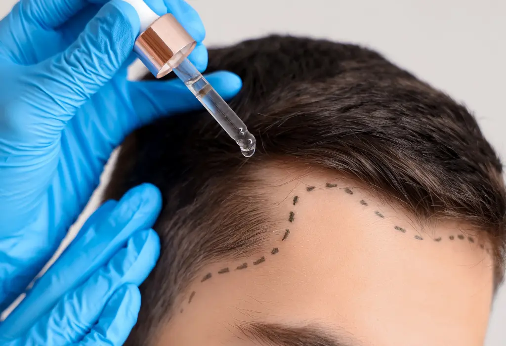 Types of Hair Loss We Assess