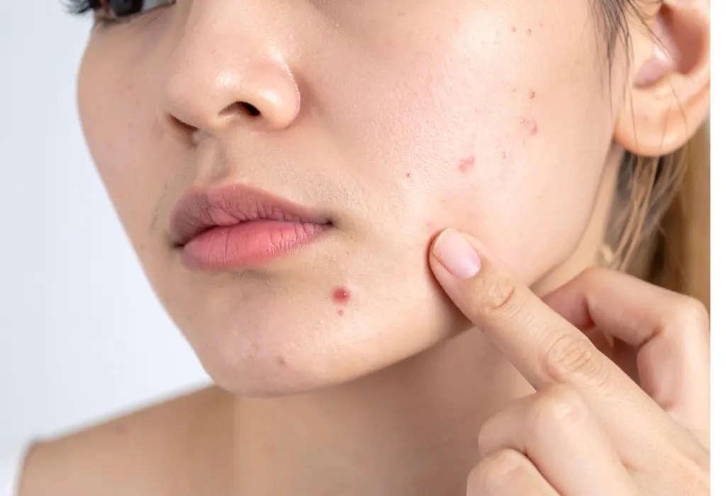 Why Acne Develops and Why It Can Be Difficult to Control