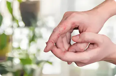Fungal Infections Aesthetic Services