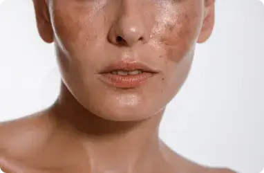 Melasma Aesthetic Services 