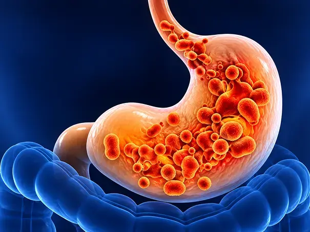 What Is Acid Reflux and GERD Treatment | Liv Med