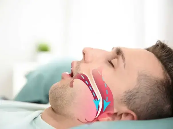 Who Should Consider a Sleep Apnea Evaluation 1